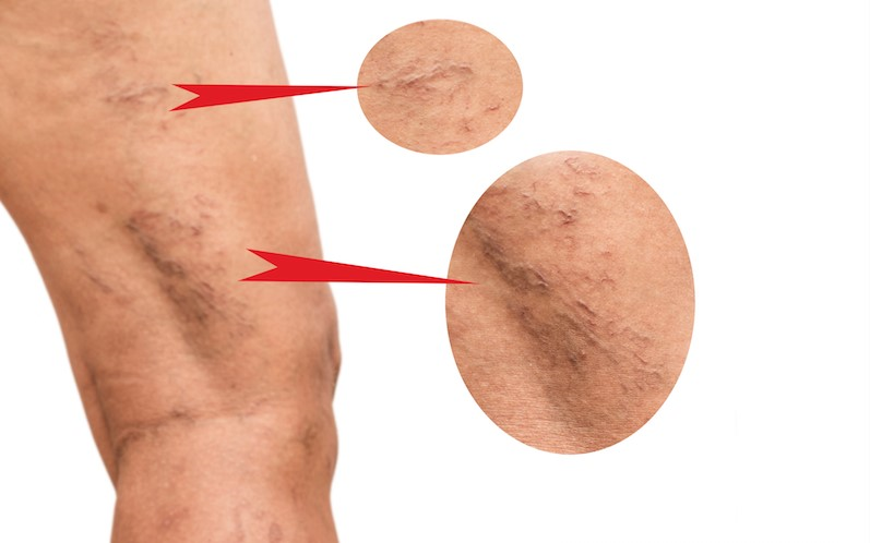 varicose veins laser